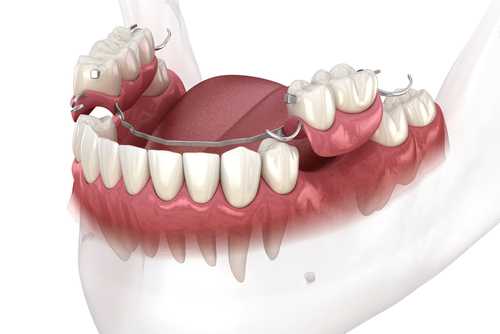 Partial Dentures in Wayne, NJ | Denture Options | Mini Implants